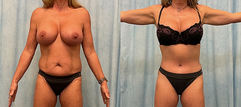 Body Contouring Before & After