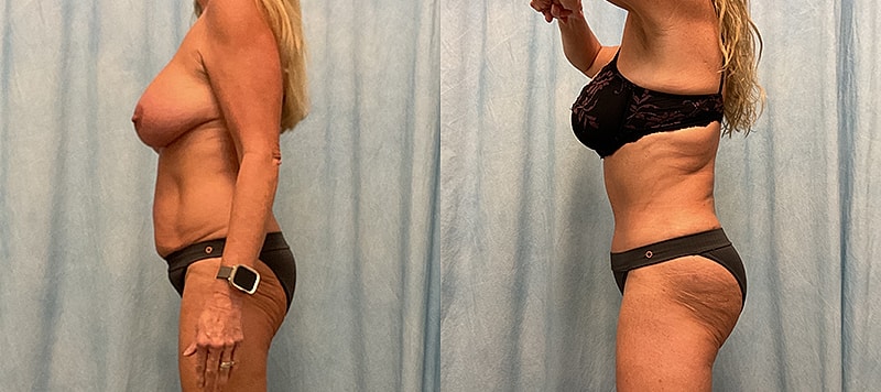 Body Contouring Before & After