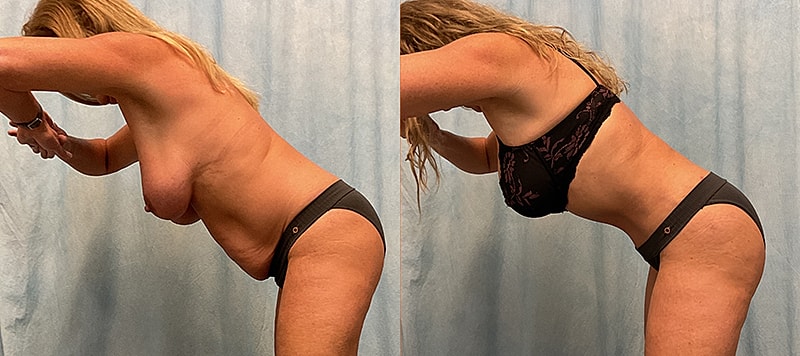 Body Contouring Before & After