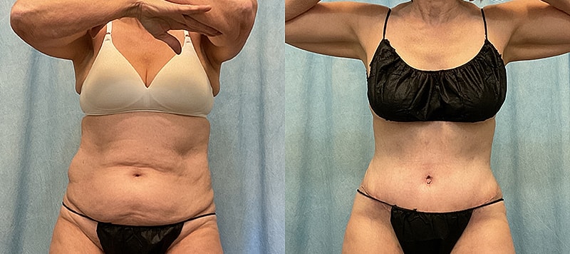 Body Contouring Before & After