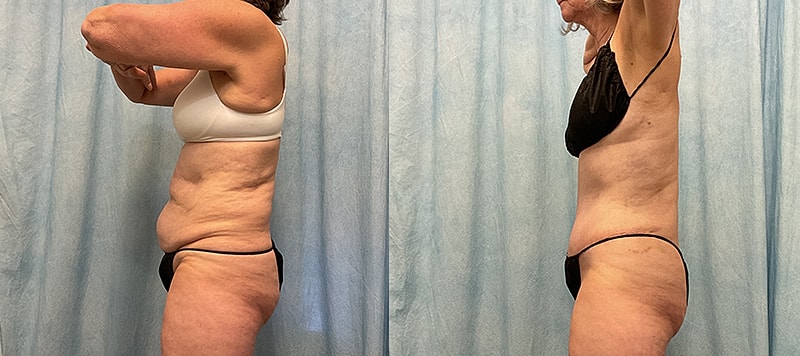 Body Contouring Before & After