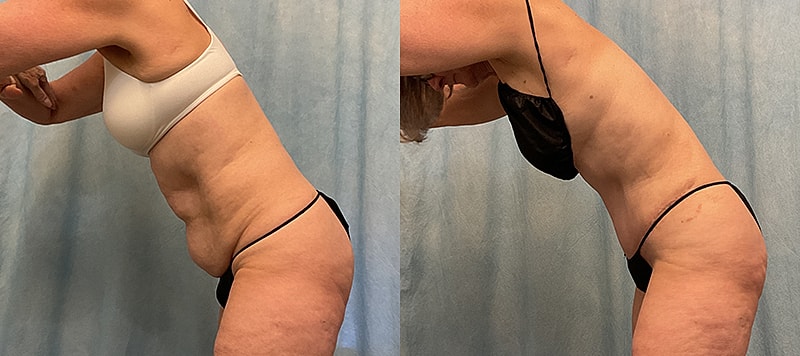 Body Contouring Before & After