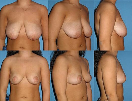 Breast Lift Before & After
