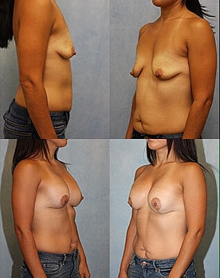 Breast Lift Before & After