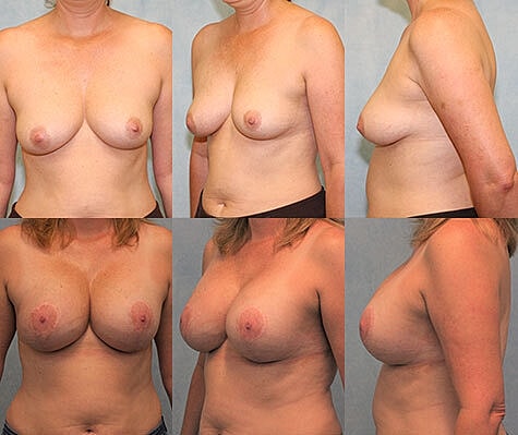 Breast Lift Before & After