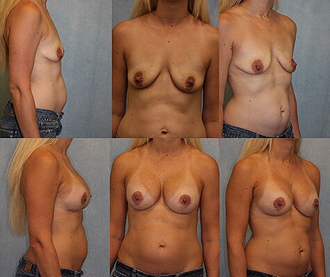 Breast Lift Before & After