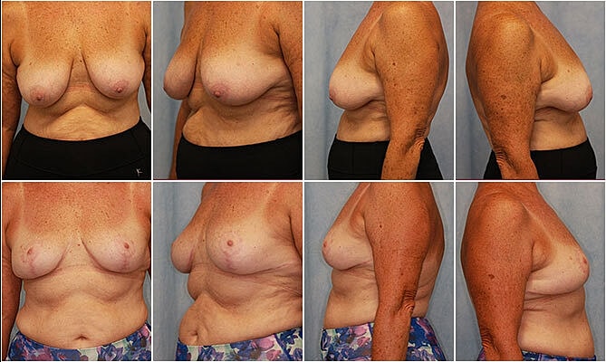 Breast Lift Before & After