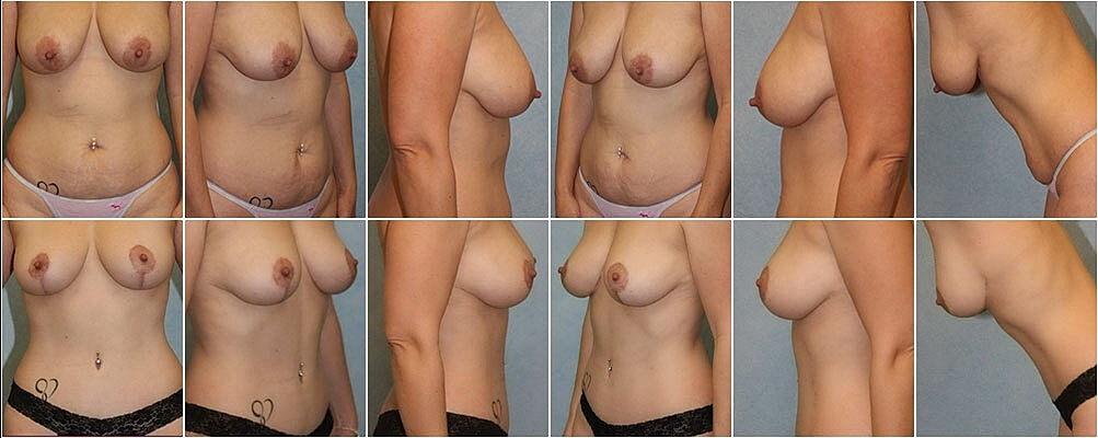 Breast Lift Before & After