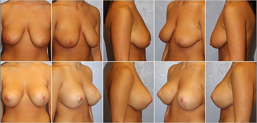 Breast Lift Before & After