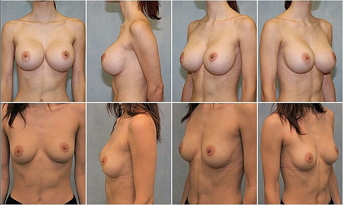 Breast Implant Removal Before & After