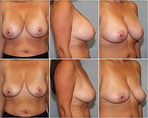 Breast Implant Removal Before & After