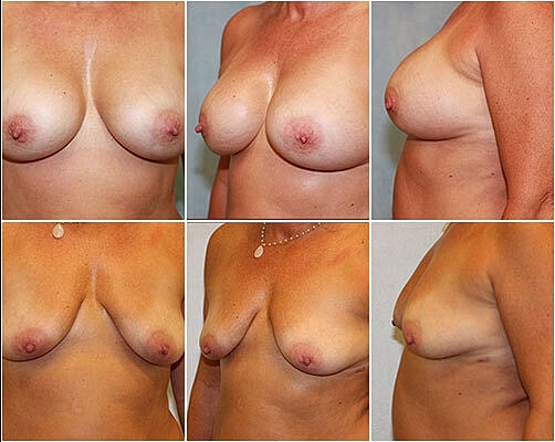 Breast Implant Removal Before & After