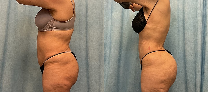 Bbl Before & After