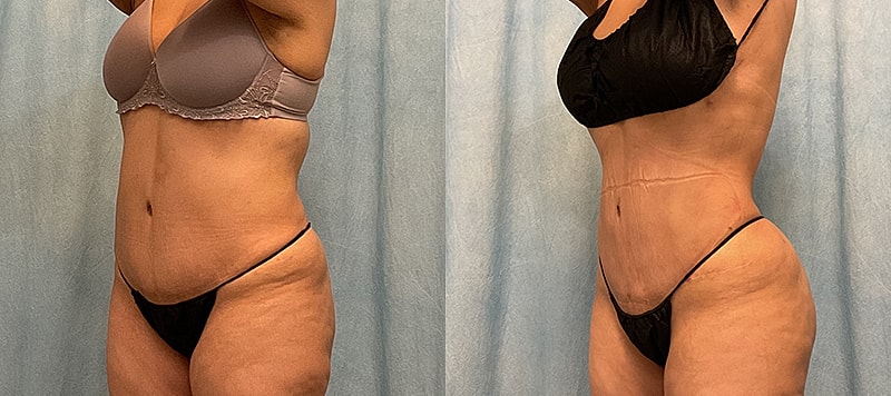 Bbl Before & After