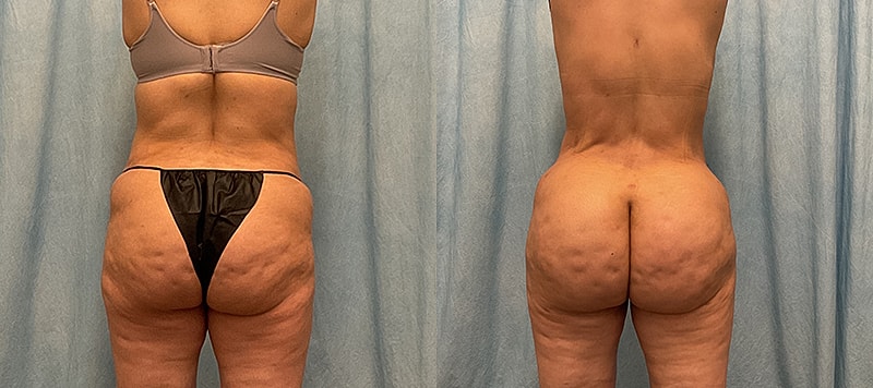 Bbl Before & After