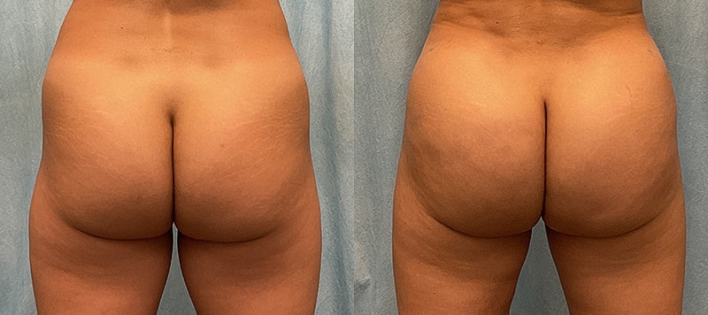 Bbl Before & After