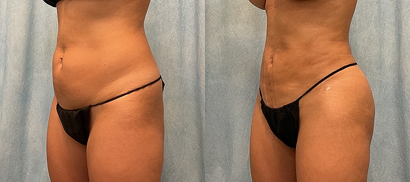 Bbl Before & After