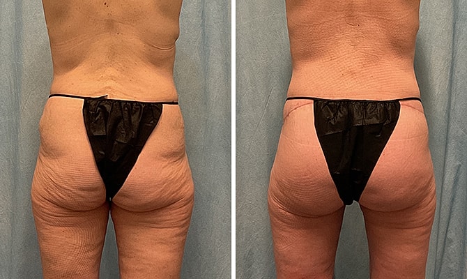 Bbl Before & After