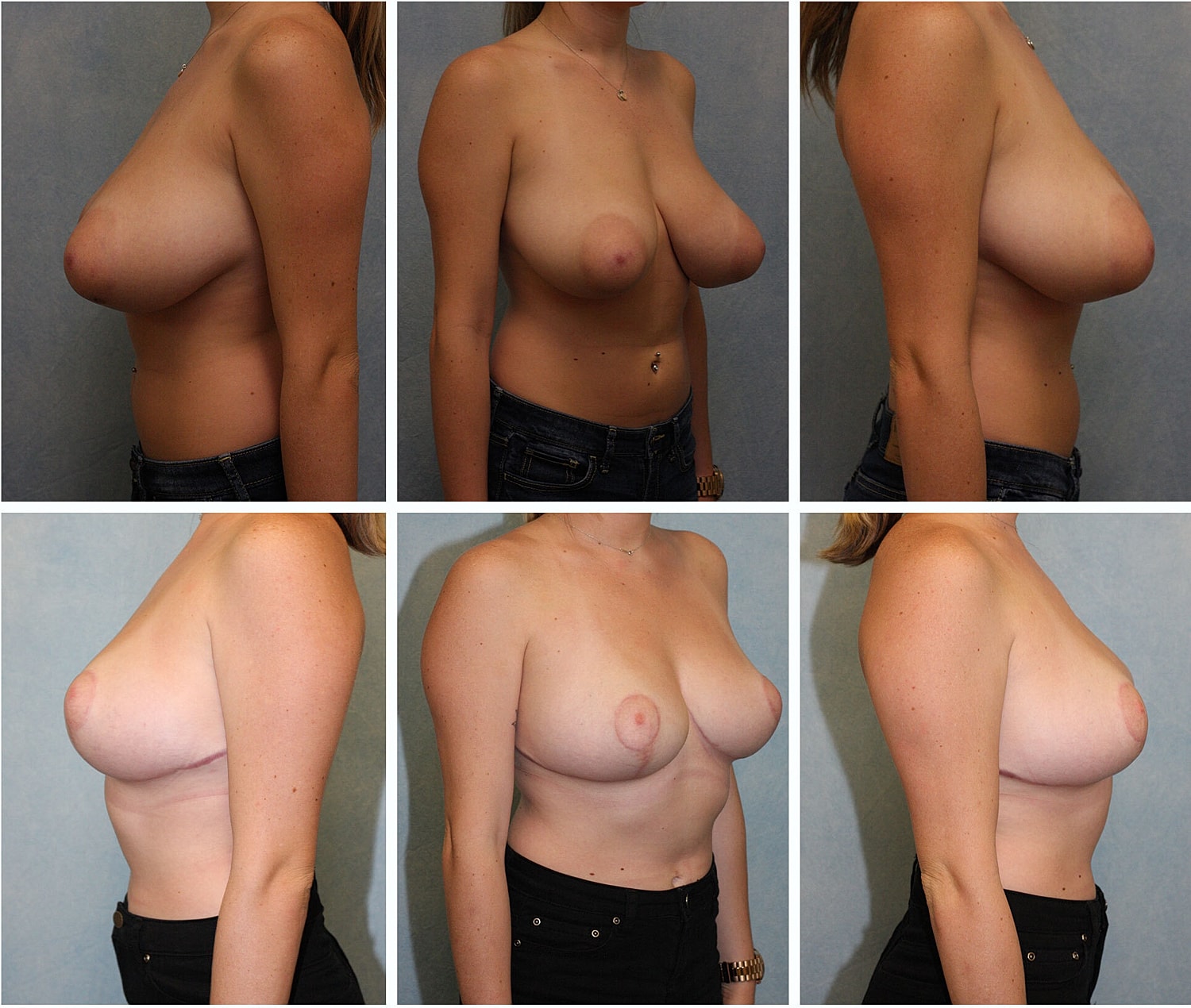 Breast Reduction Before & After