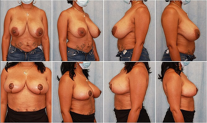 Breast Reduction Before & After