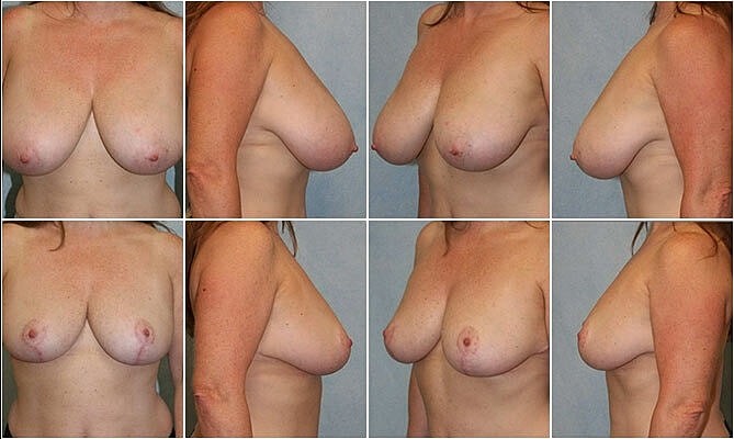 Breast Reduction Before & After