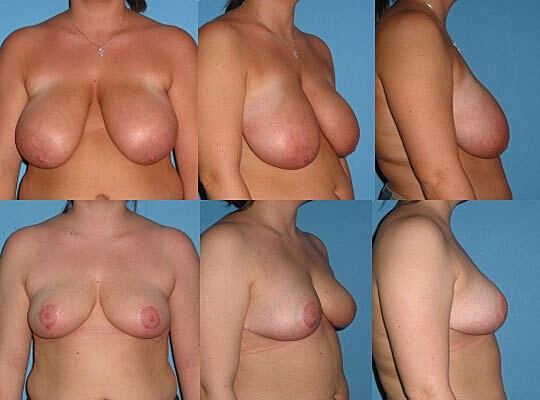 Breast Reduction Before & After