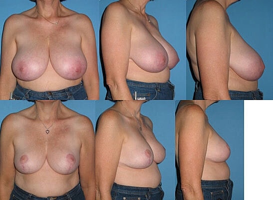 Breast Reduction Before & After