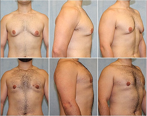 Gynecomastia Surgery Before & After