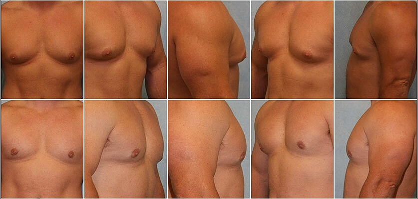 Gynecomastia Surgery Before & After