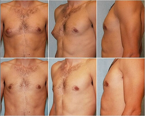 Gynecomastia Surgery Before & After