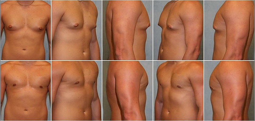 Gynecomastia Surgery Before & After