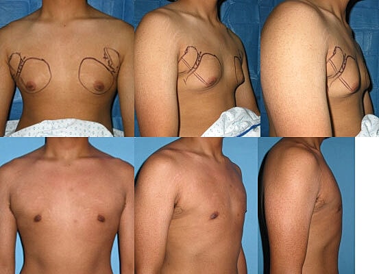 Gynecomastia Surgery Before & After