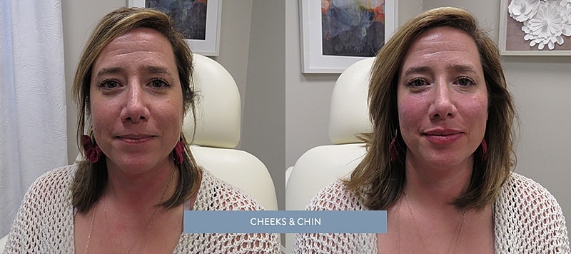 Dermal Filler Before & After