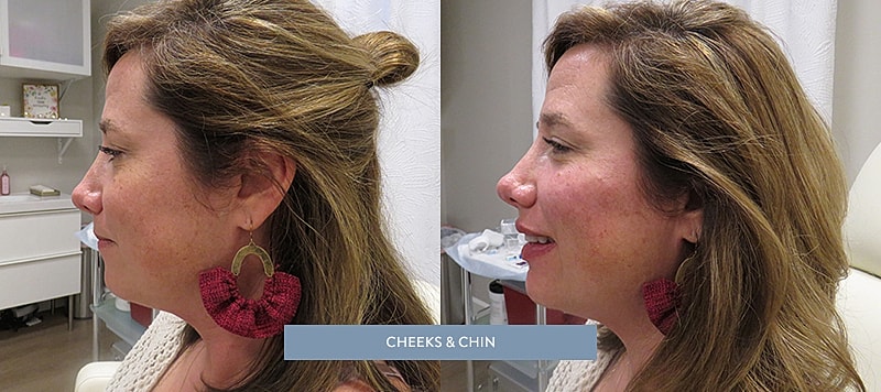 Dermal Filler Before & After