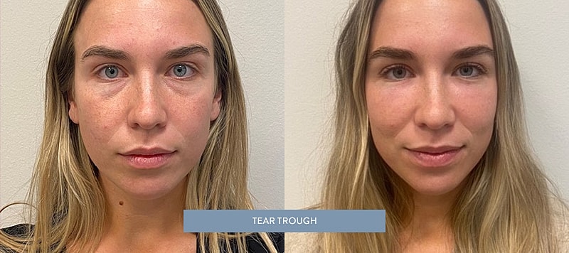 Dermal Filler Before & After