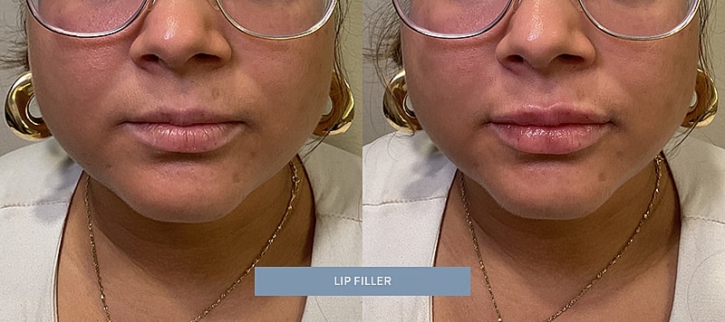 Dermal Filler Before & After
