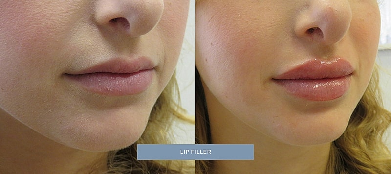Dermal Filler Before & After