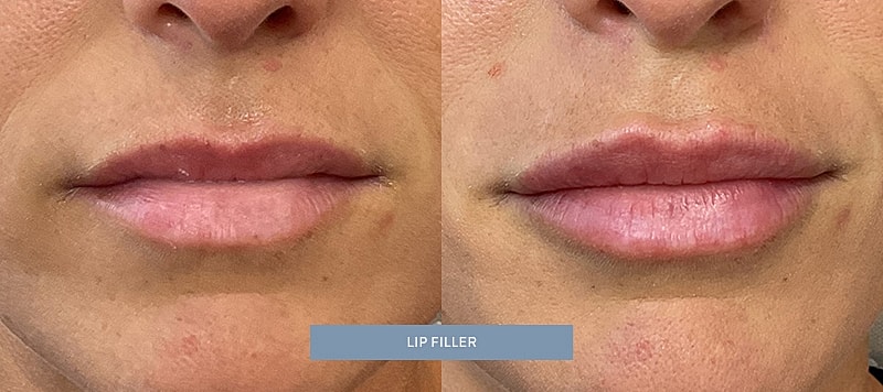 Dermal Filler Before & After
