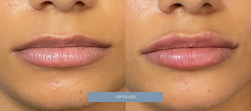 Dermal Filler Before & After
