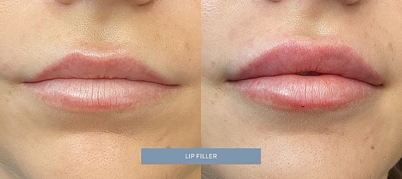 Dermal Filler Before & After