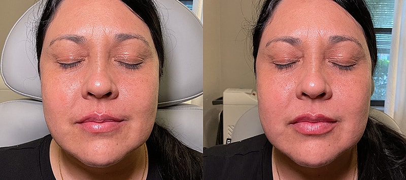 Dermal Filler Before & After