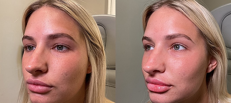 Dermal Filler Before & After