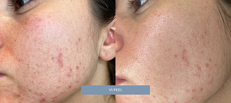 Skin Treatments Before & After