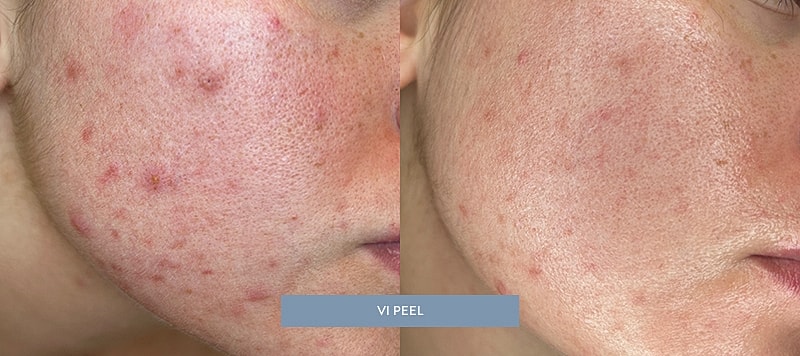 Skin Treatments Before & After