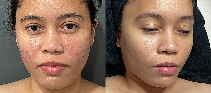 Skin Treatments Before & After