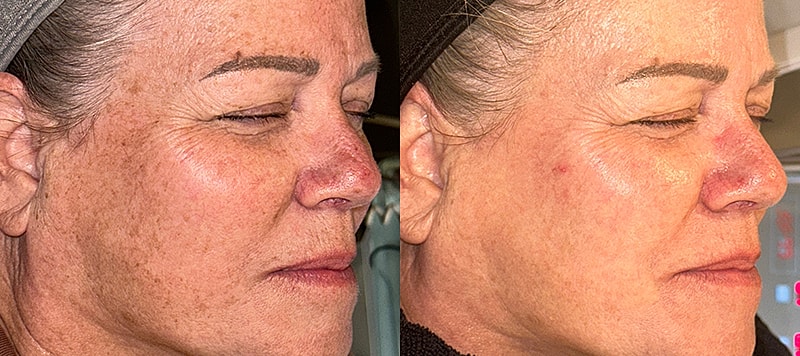 Skin Treatments Before & After