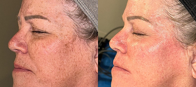 Skin Treatments Before & After
