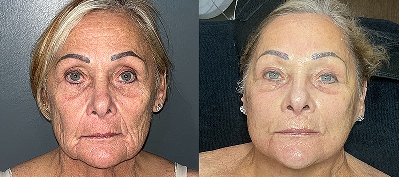 Skin Treatments Before & After