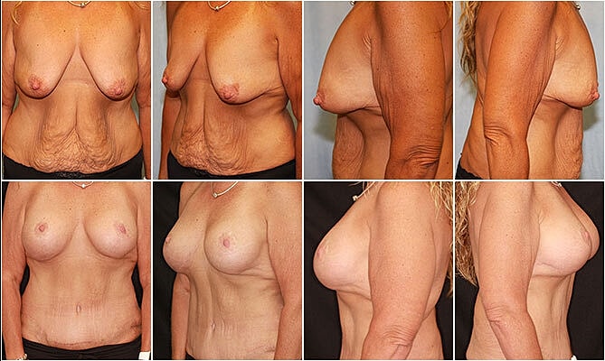 Mommy Makeover Before & After