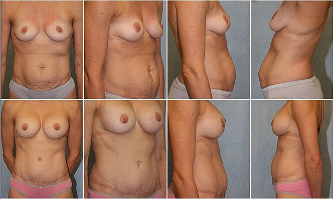 Mommy Makeover Before & After